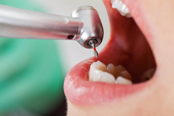 Best Emergency Tooth Extraction in Winnfield, LA